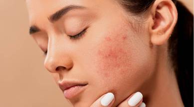 skincare, skincare routine for pimples, how to get rid of pimples, home remedy for pimples, skincare routine, indian express news