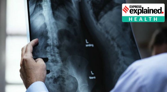 Using Covid-19 imaging patterns, they categorised each chest X-ray as characteristic, nonspecific, or negative in appearance for Covid-19. (Representational Image)