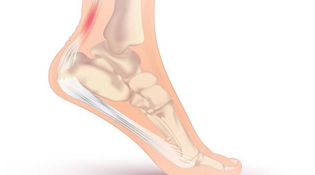 Achilles Tendonitis