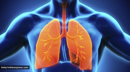 Covid pneumonia, all you need to know about covid pneumonia, indianexpress.com, indianexpress, what is covid pneumonia, pandemic, corona pneumonia, lung tissues,