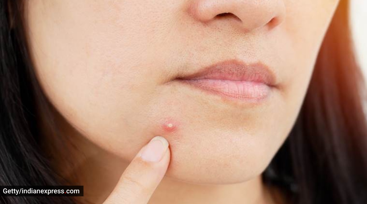 Acne breakouts, how to avoid acne, indianexpress.com, skincare, skincare for men, what causes acne, indianexpress.