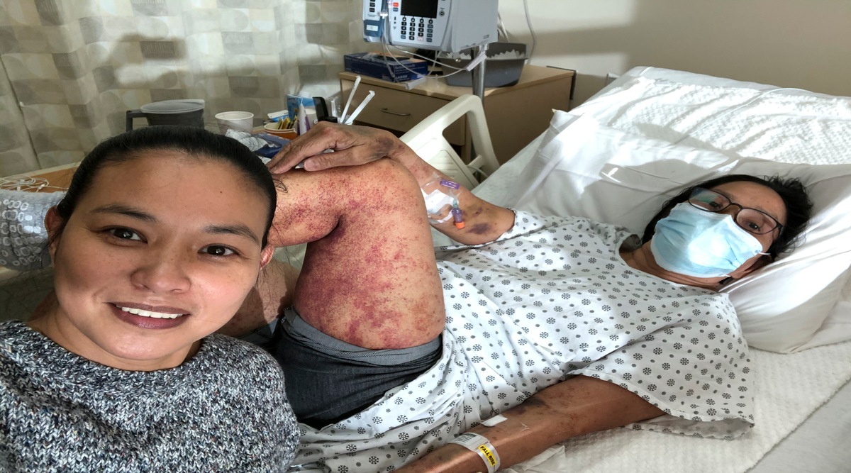 In an undated photo taken by her daughter, Luz Legaspi, who was hospitalized with a severe case of immune thrombocytopenia, showing bruising and bleeding under the skin caused by lack of platelets. A link to the vaccines is not certain, and investigations are underway in some reported cases. (Via Luz Legaspi via The New York Times) 