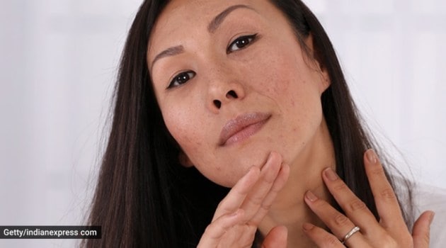 acne, skincare issues, how to fight acne scars, acne scar remedies, home remedies for acne scars, indianexpress.com, indianexpress