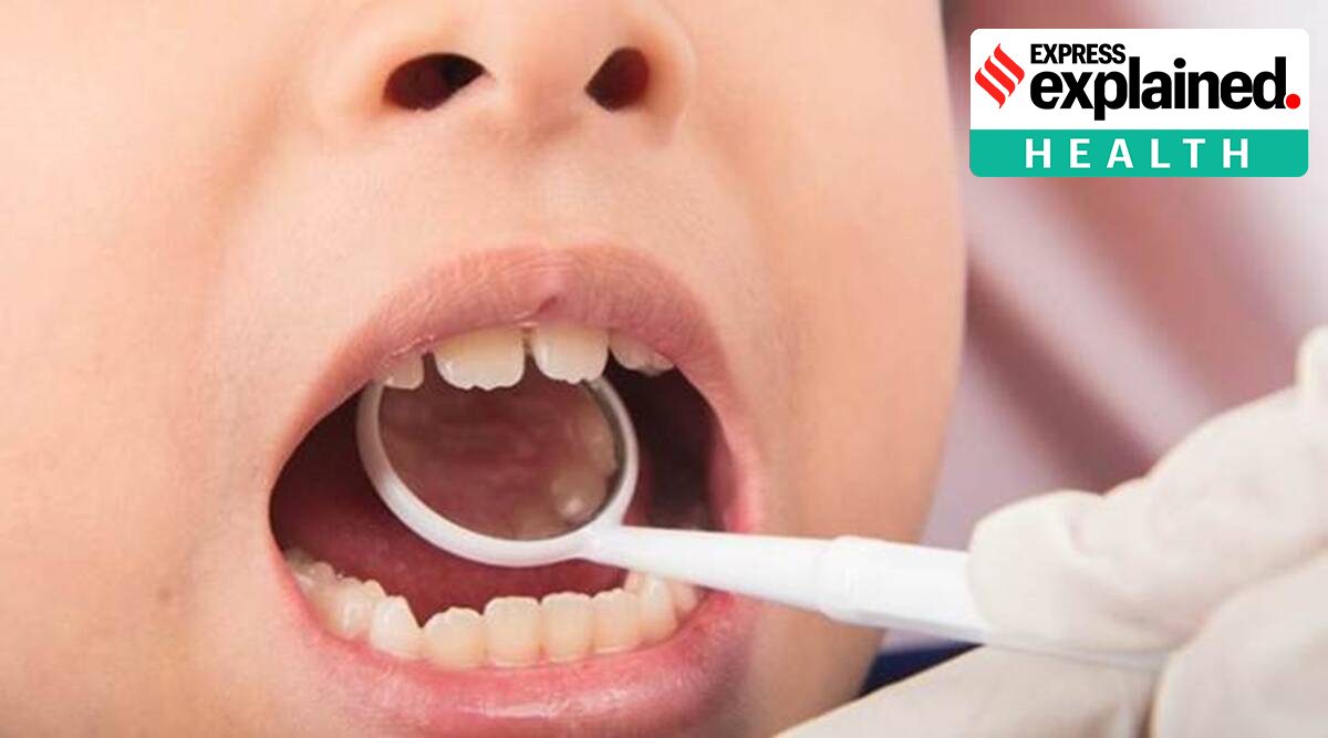 COVID tongue is an inflammatory disorder that usually appears on the top and sides of the tongue. (Representational Image)