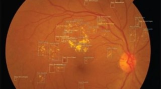 netra ai, netra ai intel, netra ai diabetic retinopathy, netra ai sankara eye foundation india, netra ai leben care singapore, netra ai glaucoma, how netra ai works