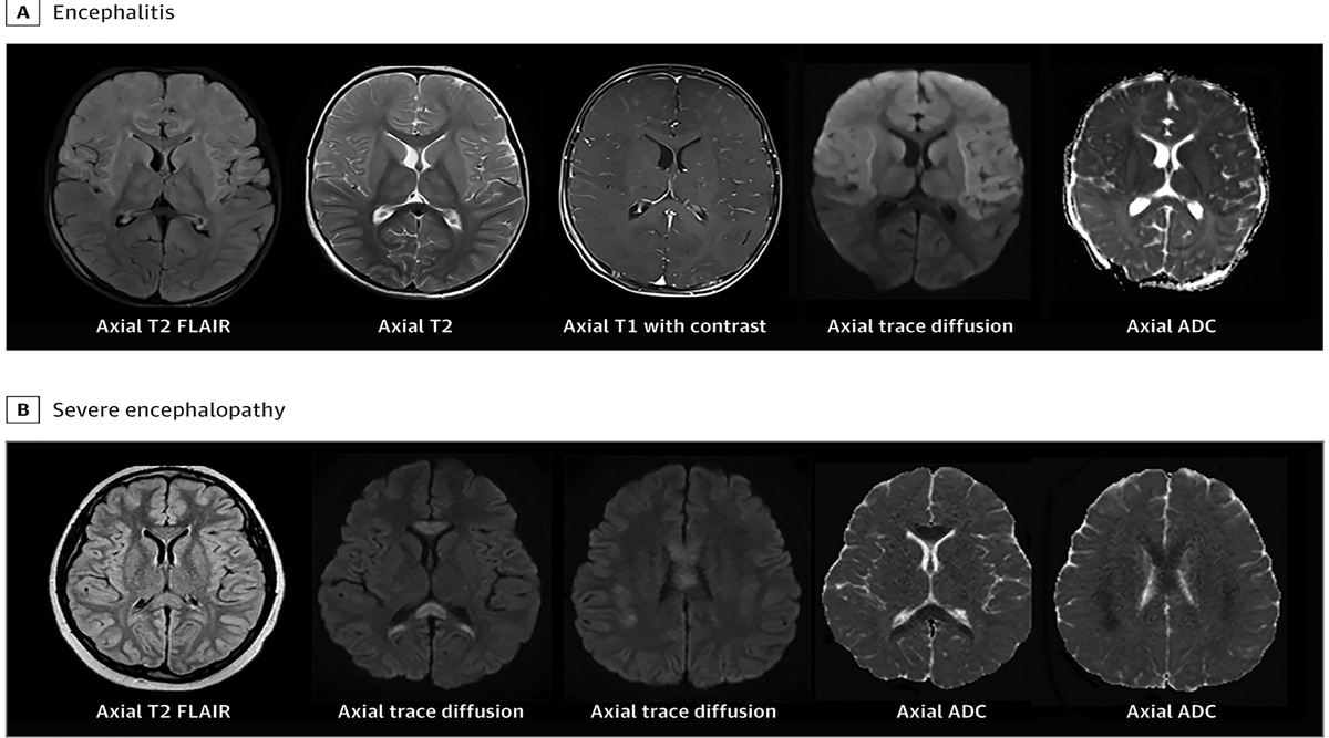 Some children with COVID-related syndrome develop neurological symptoms ...