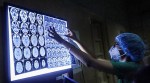 Unholy trinity: Diabetes, rampant use of steroids amid Covid appear to increase mucormycosis: Study