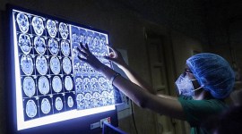 Unholy trinity: Diabetes, rampant use of steroids amid Covid appear to increase mucormycosis: Study