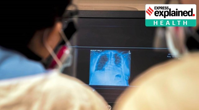 Doctors look at a scan of the lungs of a Covid infected patient (File photo)