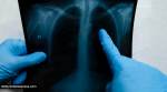 what is bilateral pleural effusion, what causes bilateral pleural effusion, treatment for bilateral pleural effusion, signs and symptoms of bilateral pleural effusion, dilip kumar bilateral pleural effusion, indian express news