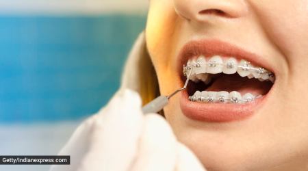 what are braces, when do you need braces, crooked teeth, teeth misalignment, signs that you need braces, can adults wear braces, dental health and hygiene, indian express news