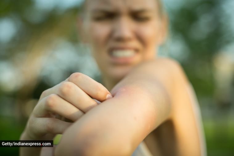 myggbitt, biter mygg noen mennesker mer enn andre, hva gjør mygg bite mennesker, hvorfor biter mygg, indian express news