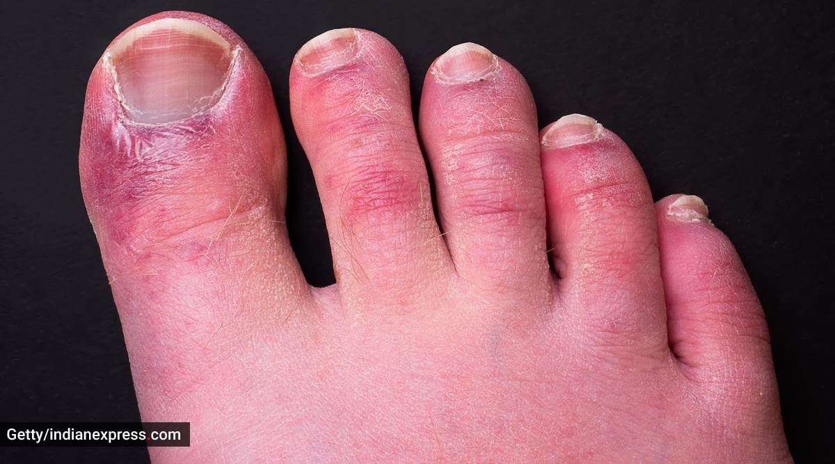 Covid Toes Know The Symptoms Causes Prevention Treatment Health   Covid Toes 1200 Getty 