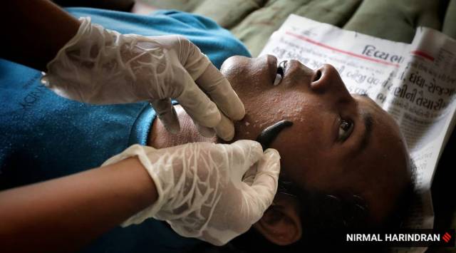 leech therapy, ayurveda, black fungus