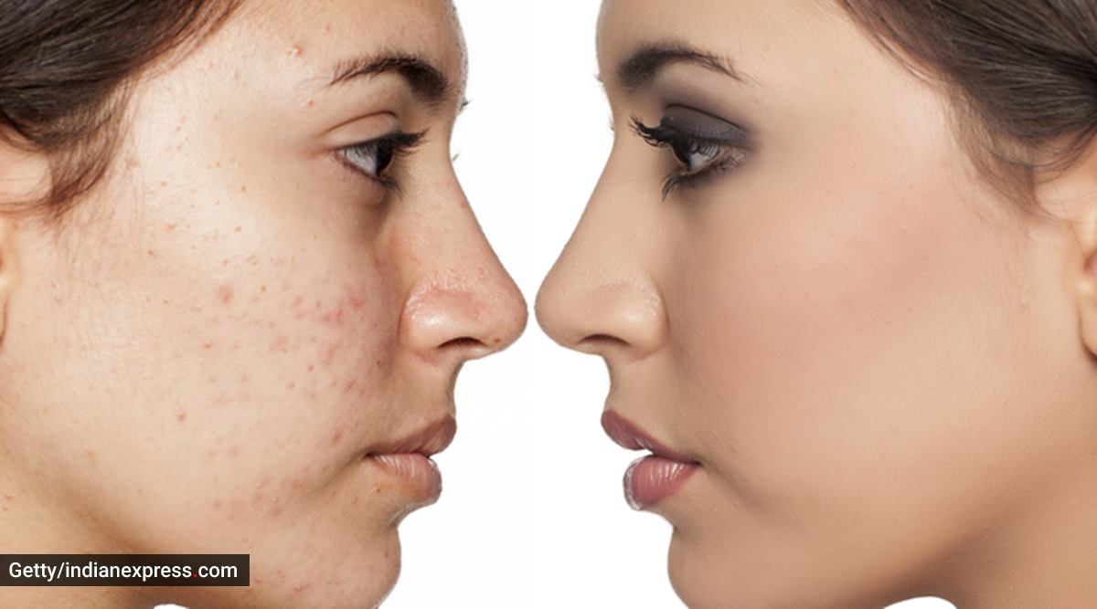 How To Start A Business With acne