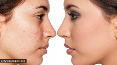 skincare, skincare tips, what causes acne, everyday habits that can cause acne, bad skincare habits, how to get rid of acne problem, indian express news
