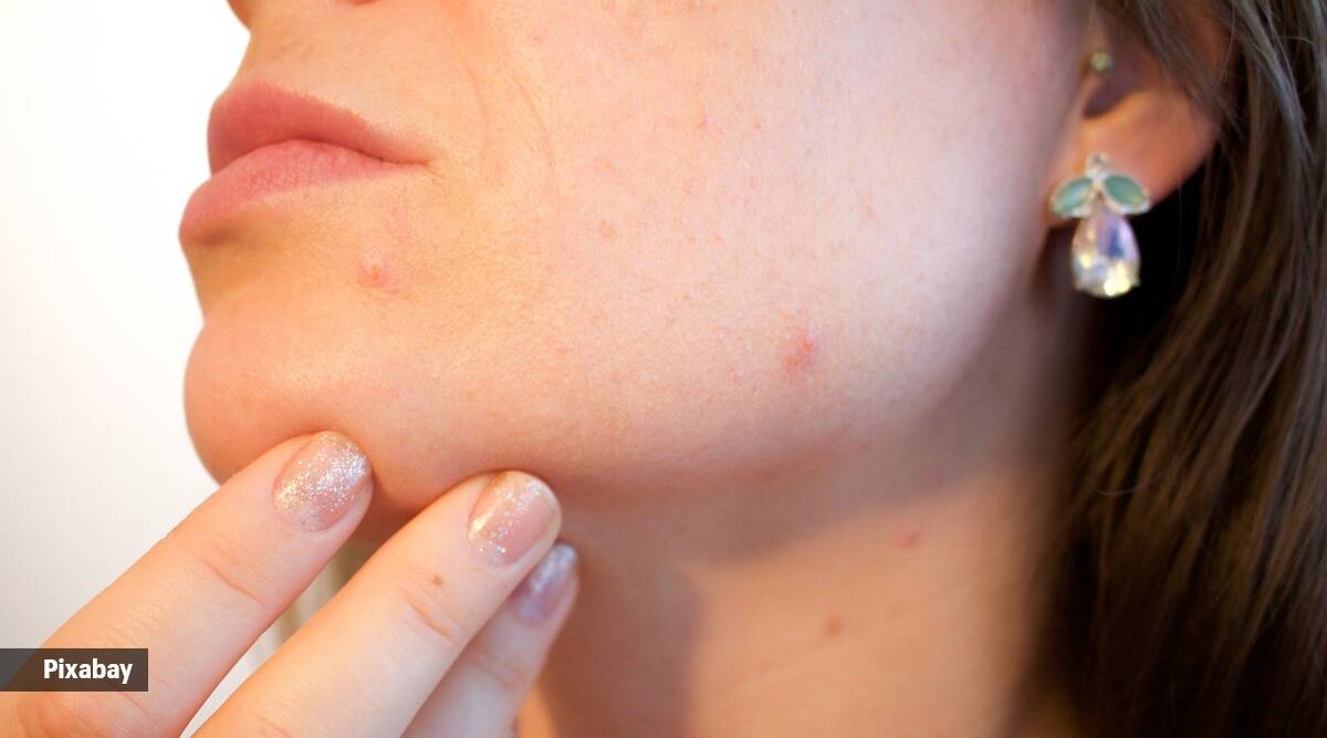 acne, makeup