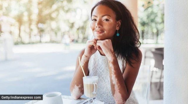 vitiligo, skin disorder