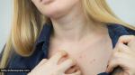 skincare, skincare tips, skincare tips for acne, breast acne, acne on the breast, acne near the breast, skincare routine, breast acne tips, indian express news
