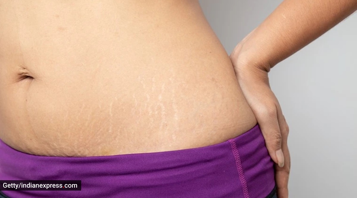 Say goodbye to stretch marks with these natural remedies | Lifestyle  News,The Indian Express