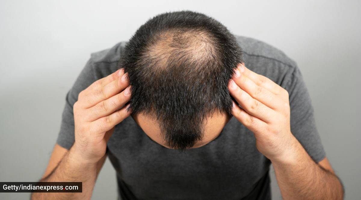 Alopecia Areata  Causes Symptoms  Treatment