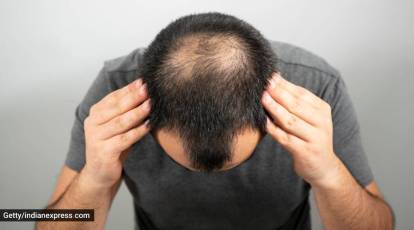 Baldness: Know about the various types and their causes | Lifestyle  News,The Indian Express