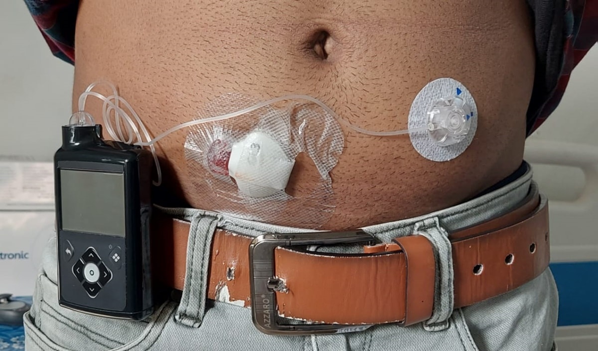 What is Artificial Pancreas, how does it work, cost, features