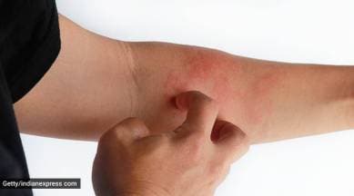 winter rash
