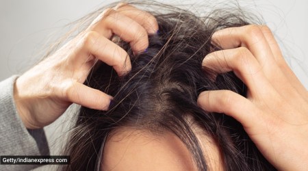 acne, scalp acne, what cause acne in the scalp, how to take care of scalp acne, treatment for scalp acne, skincare, indian express news