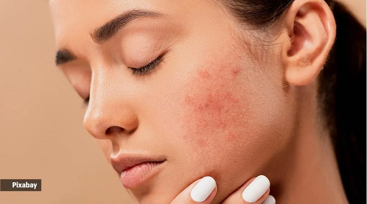 Skincare alert Tips to quickly treat a pimple ahead of an important occasion Life-style News image