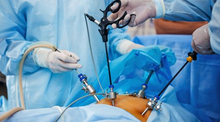 Laparoscopic  Hysterectomy 