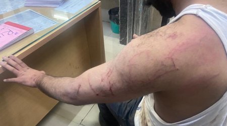 One of the injured getting examined at the Civil Hospital. (Express Photo)