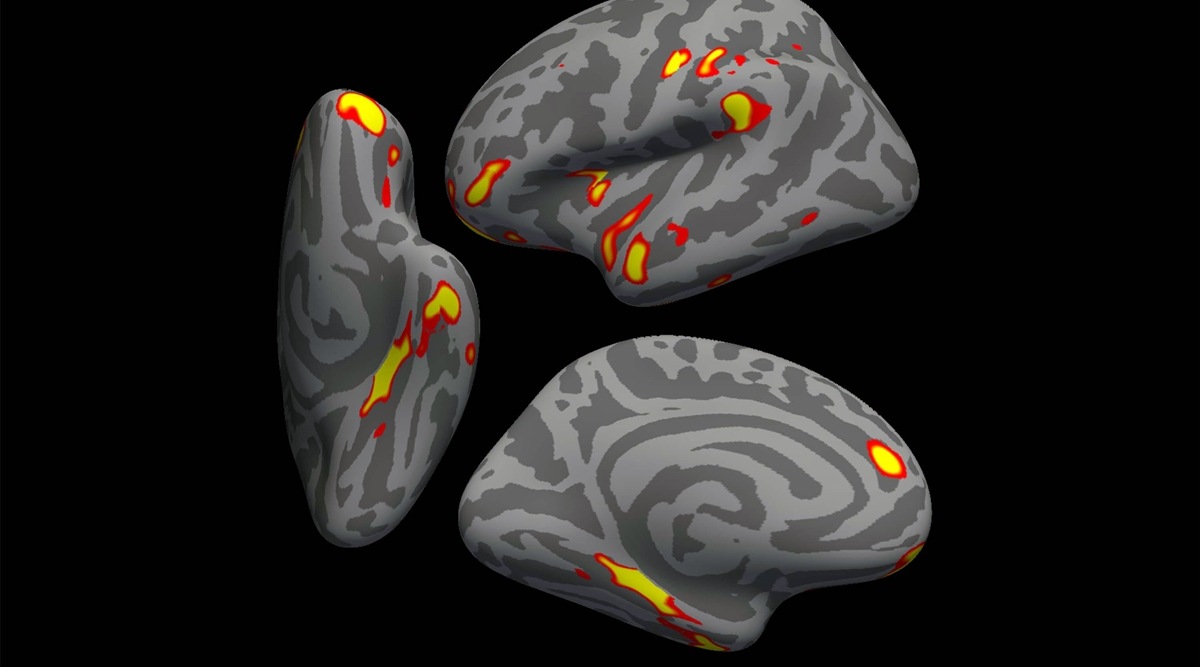 An image provided by the University of Oxford and the US National Institutes of Health shows a digital model of a human brain showing the parts of the brain that lost the most gray matter in the 401 Covid-infected participants in a study, in red-yellow. (G. Douaud, Anderson Winkler and Saad Jbabdi/University of Oxford and NIH via The New York Times) 