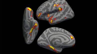 An image provided by the University of Oxford and the US National Institutes of Health shows a digital model of a human brain showing the parts of the brain that lost the most gray matter in the 401 Covid-infected participants in a study, in red-yellow. (G. Douaud, Anderson Winkler and Saad Jbabdi/University of Oxford and NIH via The New York Times)