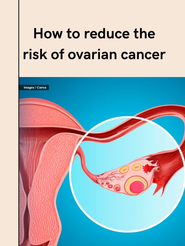 How to reduce the risk of ovarian cancer | The Indian Express