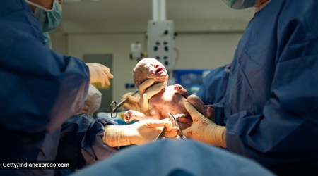 Caesarean delivery, all you need to know about Caesarean delivery, what happens during Caesarean delivery, recovery time for Caesarean delivery, things to do for health and recovery after C-section birth, indian express news