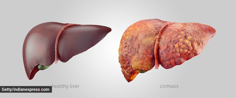 World Liver Day 2022, World Liver Day, liver health, healthy liver, unhealthy liver, signs of an unhealthy liver, cirrhosis, liver cirrhosis, health, indian express news