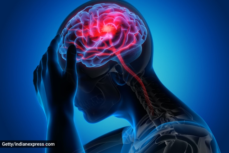 migraine, migraine headache, migraine pain, how to treat migraine pain, migraine triggers, what triggers migraine pain, chronic migraine, indian express news