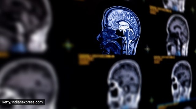 cerebral aneurysm, what is cerebral aneurysm, what causes cerebral aneurysm, treatment for cerebral aneurysm, symptoms of cerebral aneurysm, indian express news