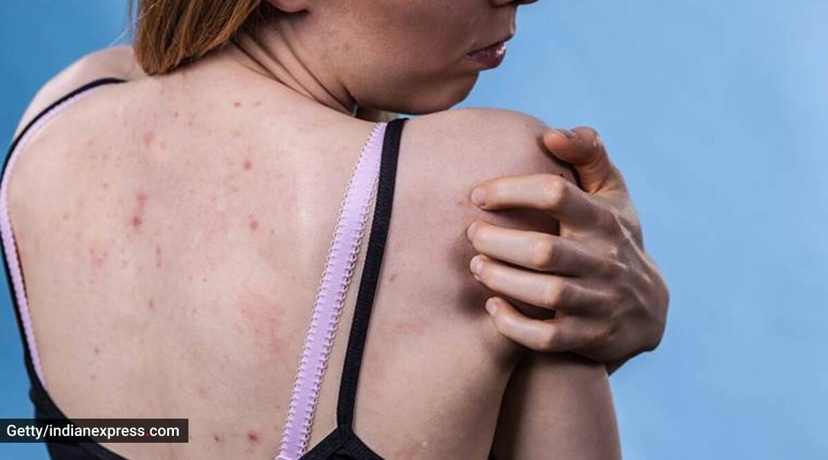 back acne