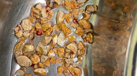 Doctors in Hyderabad removed as many as 206 kidney stones from a 56-year-old patient after a one-hour keyhole surgery. 