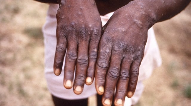 The dorsal surfaces of the hands of a monkeypox case patient. (AP/PTI Photo, File)