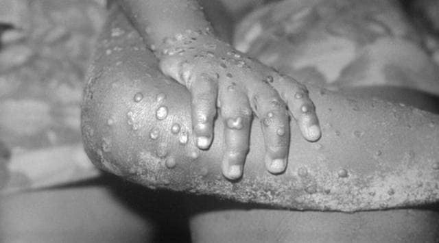 The monkeypox virus is a slow-mutating DNA virus that is spread through large respiratory droplets and requires prolonged close contact with a patient for transmission. (Representative/Wiki Commons)