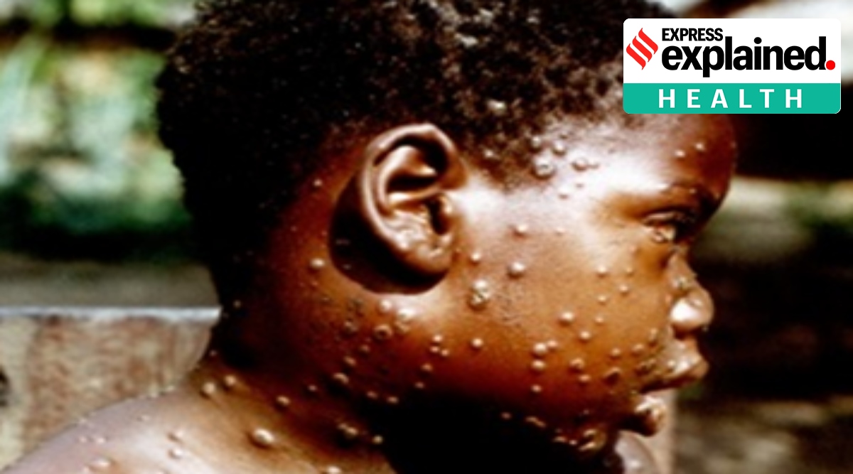 What is monkeypox?