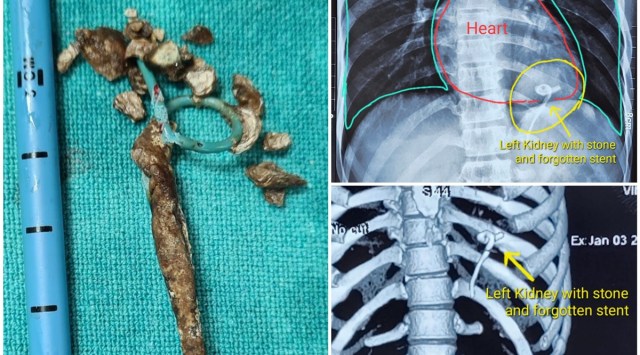 Doctors at the Nizam's Institute of Medical Sciences (NIMS) in Hyderabad removed kidney stones and a discarded stent from a 22-year-old man's kidney.