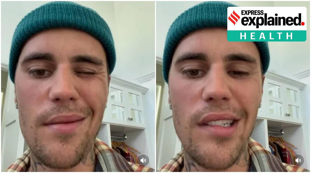 In an Instagram video, Bieber revealed he has been diagnosed with a condition called ‘Ramsay Hunt Syndrome’, which has fully paralysed the right side of his face. (Justin Bieber/Instagram)