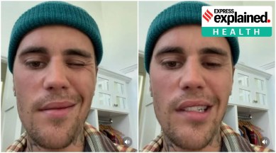 In an Instagram video, Bieber revealed he has been diagnosed with a condition called ‘Ramsay Hunt Syndrome’, which has fully paralysed the right side of his face. (Justin Bieber/Instagram)
