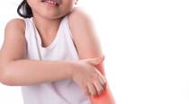 Skin Allergies in Children – What parents need to know