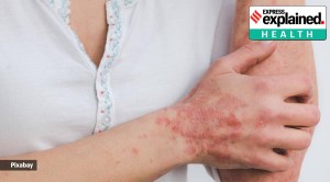 Why women itch less than men: study finds key in a hormone