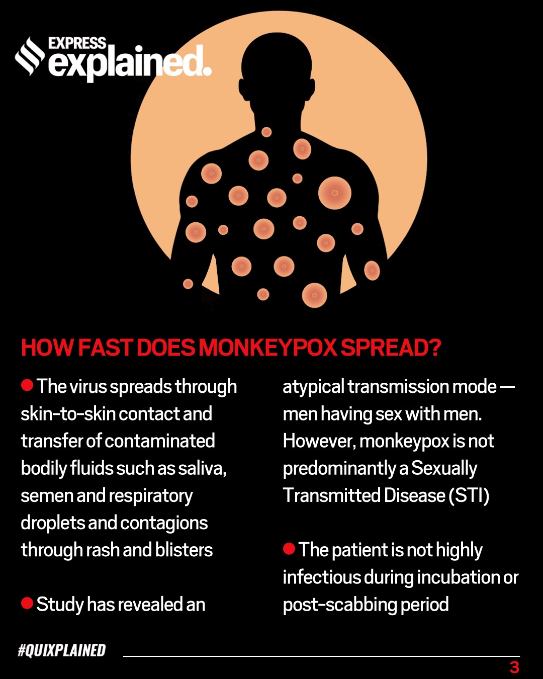 Monkeypox Symptoms, prevention, and treatment explained